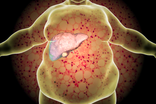 esteatose hepática