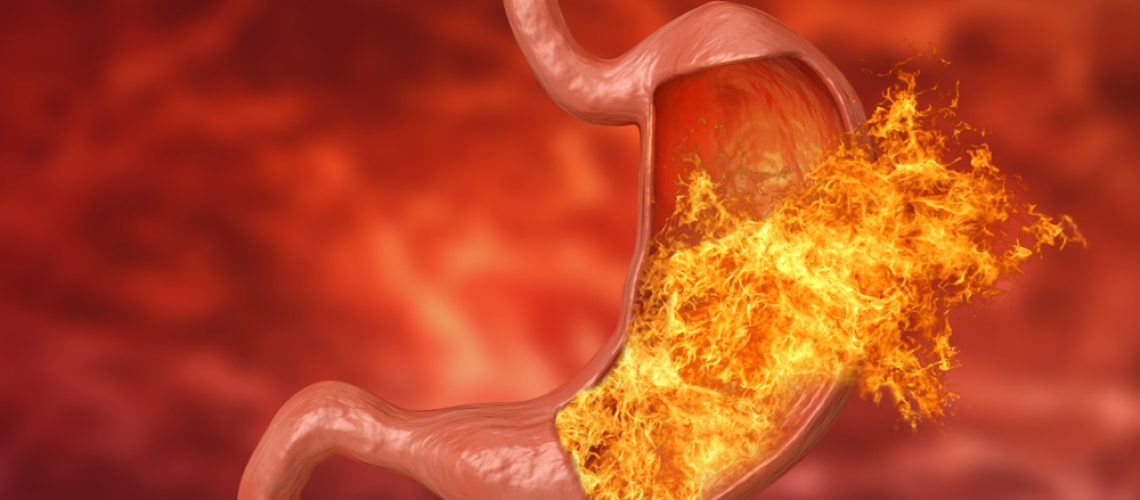 queimação no estômago